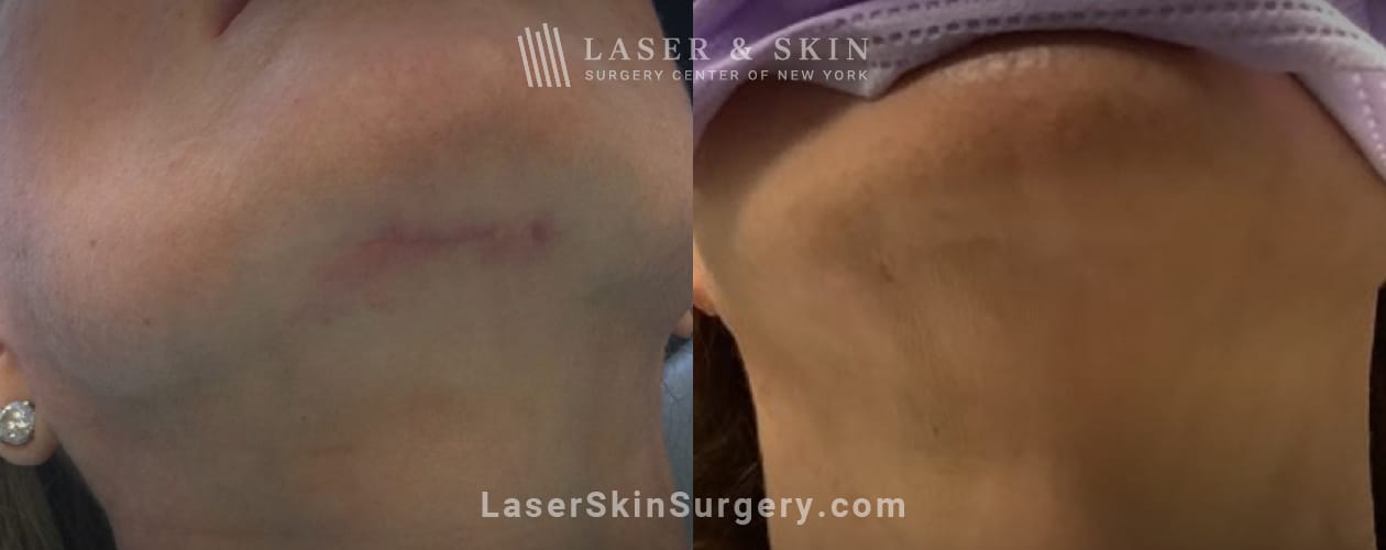 laser scar removal results on a female patient