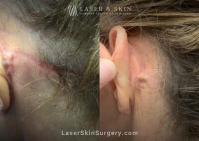 Picoplus laser treatments to remove tattoo behind the ear