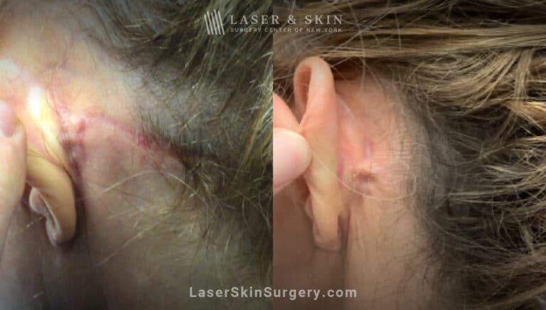 Picoplus laser treatments to remove tattoo behind the ear