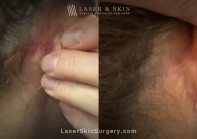 Picoplus laser treatments to remove ear tattoo