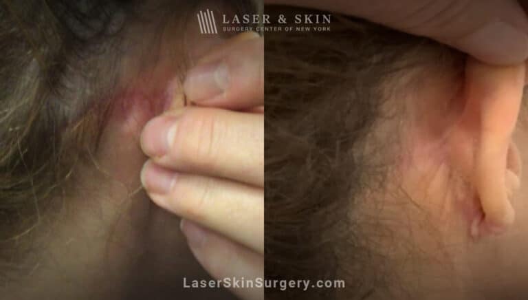 Picoplus laser treatments to remove ear tattoo