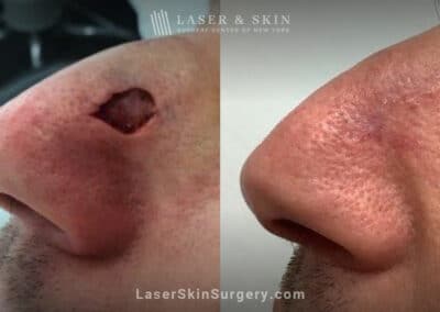 Mohs surgery to remove skin cancer from the side of the nose