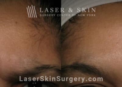 Botox injections to treat 11 lines between the eyebrows