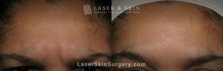 Botox injections to treat 11 lines between the eyebrows