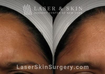 Botox injections to treat 11 lines between the eyebrows