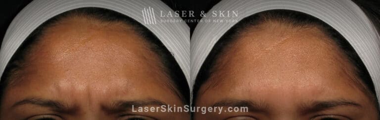 Botox injections to treat 11 lines between the eyebrows