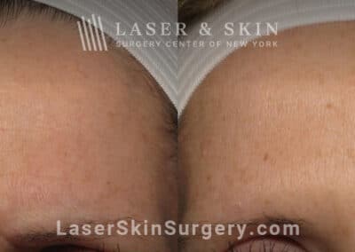 Botox injections to treat 11 lines between the eyebrows