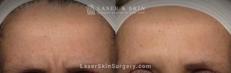 Botox injections to treat 11 lines between the eyebrows