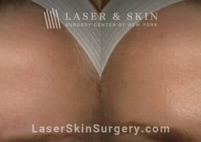 Botox injections to treat 11 lines between the eyebrows