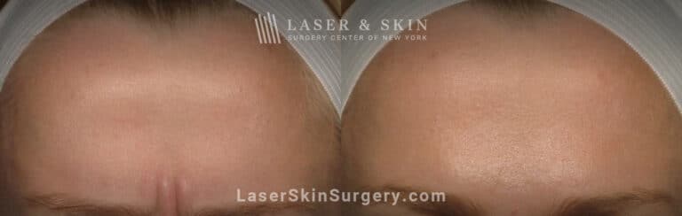 Botox injections to treat 11 lines between the eyebrows