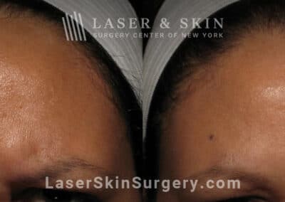 Botox injections to treat 11 lines between the eyebrows