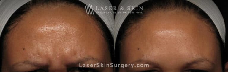 Botox injections to treat 11 lines between the eyebrows