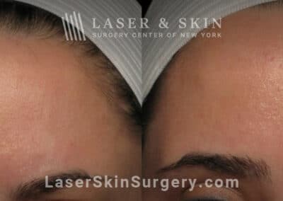 Botox injections to treat 11 lines between the eyebrows