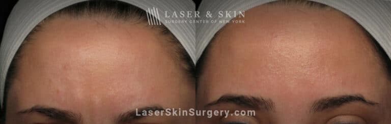 Botox injections to treat 11 lines between the eyebrows