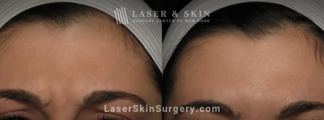 preventative botox before and after