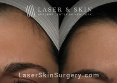 Botox to treat 11 lines between the eyebrows