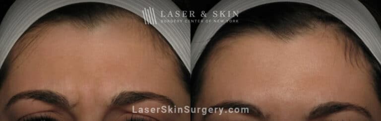Botox to treat 11 lines between the eyebrows