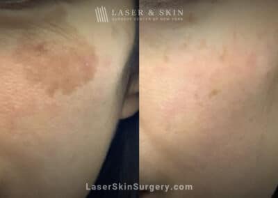 Picoplus treatments to remove lentigo brown spot from cheek