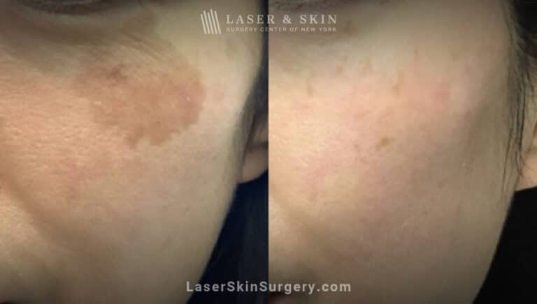 Picoplus treatments to remove lentigo brown spot from cheek