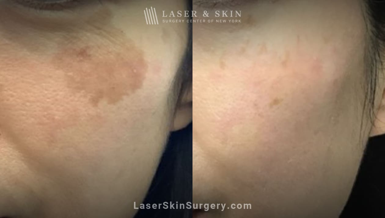 LSSC-Before&After-Dr_Geronemus_brown_spot_on_cheek_Lentigo-Pico-plus-laser-one-treatment-01-30-2023 hyperpigmentation on sun damaged skin treated by lasers