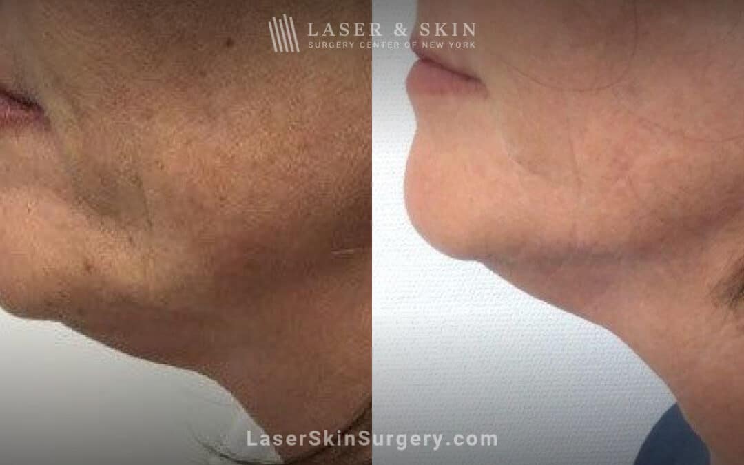 ultherapy and sofwave treatment results in nyc