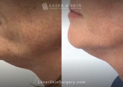 Ultherapy to tighten the skin beneath the chin