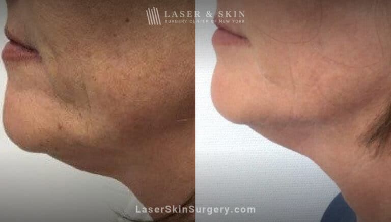 Ultherapy to tighten the skin beneath the chin