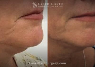 Ultherapy and Sofwave to tighten the skin beneath the chin