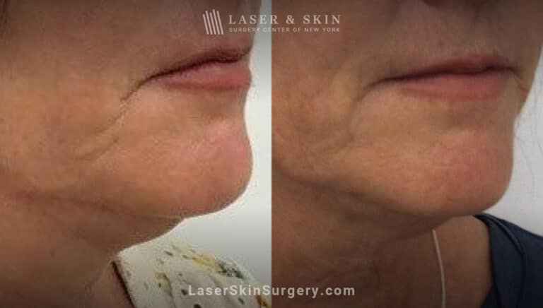 Ultherapy and Sofwave to tighten the skin beneath the chin