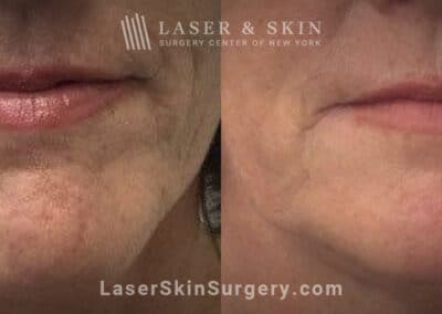 Ultherapy and Sofwave to tighten the skin beneath the chin