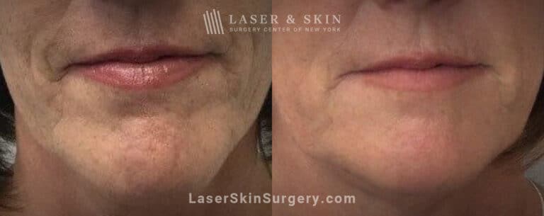 Ultherapy and Sofwave to tighten the skin beneath the chin