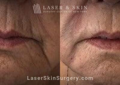 Lip filler to rejuvenate the mouth