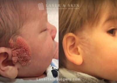 4 erbium treatments to treat child’s face