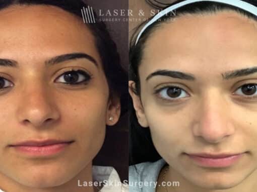 Genius microneedling treatments to rejuvenate skin with acne scars