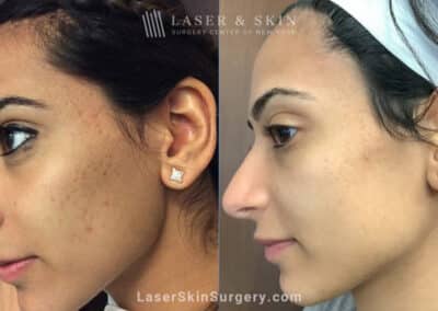 Genius microneedling treatments to rejuvenate skin with acne scars