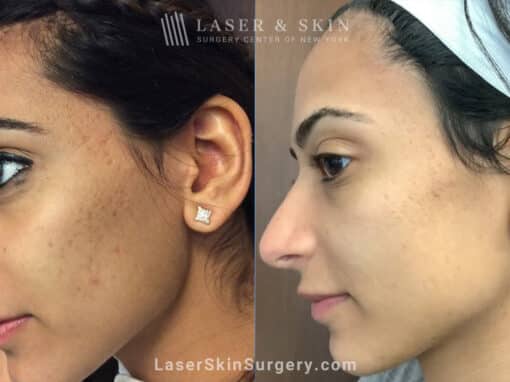 Genius microneedling treatments to rejuvenate skin with acne scars