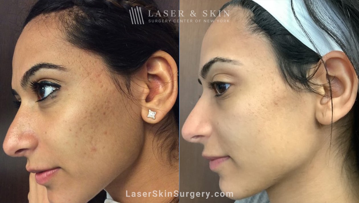 Boxcar clearance acne scars