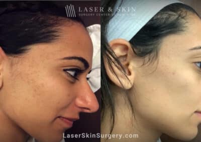 Genius microneedling treatments to rejuvenate skin with acne scars
