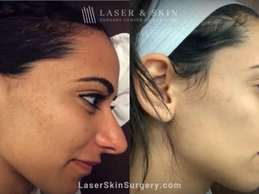 Genius microneedling treatments to rejuvenate skin with acne scars