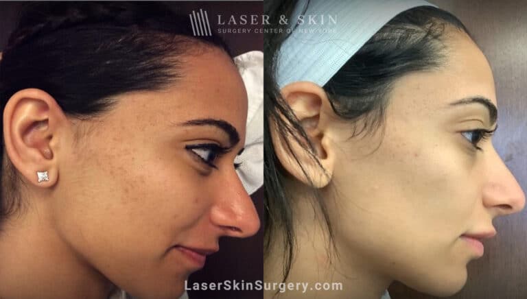 Genius microneedling treatments to rejuvenate skin with acne scars