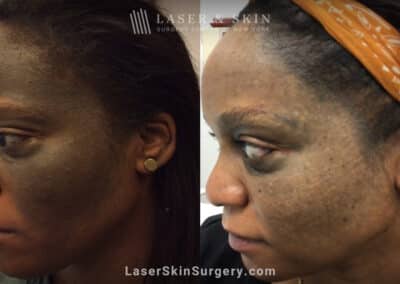 Picoplus treatments to address pigmented lesion