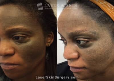 Picoplus treatments to address pigmented lesion