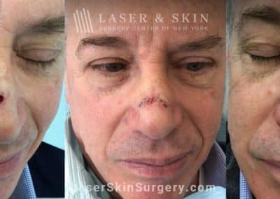 Fraxel restore treatments after Mohs surgery to remove skin cancer from the nose