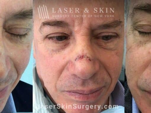 Fraxel restore treatments after Mohs surgery to remove skin cancer from the nose