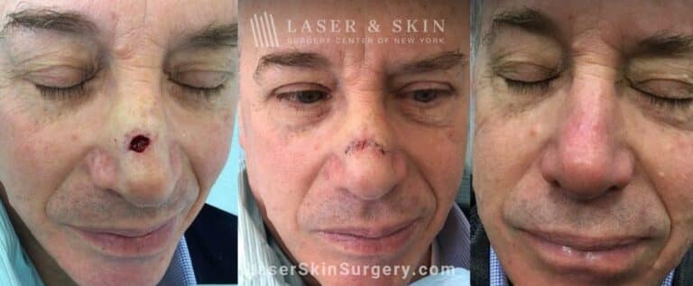 Fraxel restore treatments after Mohs surgery to remove skin cancer from the nose