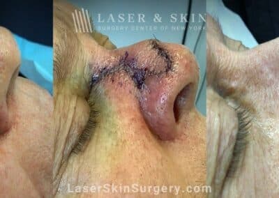 Fraxel restore treatments after Mohs surgery to remove skin cancer from the nose