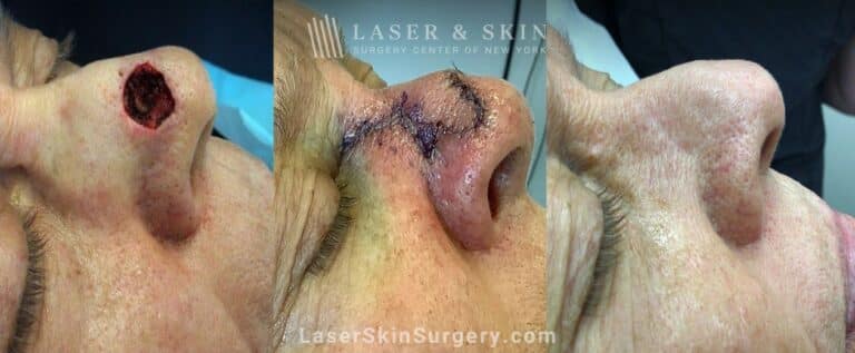 Fraxel restore treatments after Mohs surgery to remove skin cancer from the nose