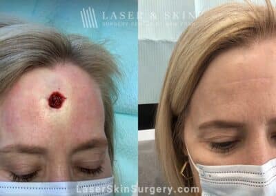 Basal cell carcinoma reconstruction to repair forehead after skin cancer removal
