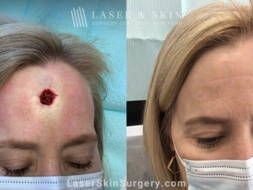 Basal cell carcinoma reconstruction to repair forehead after skin cancer removal