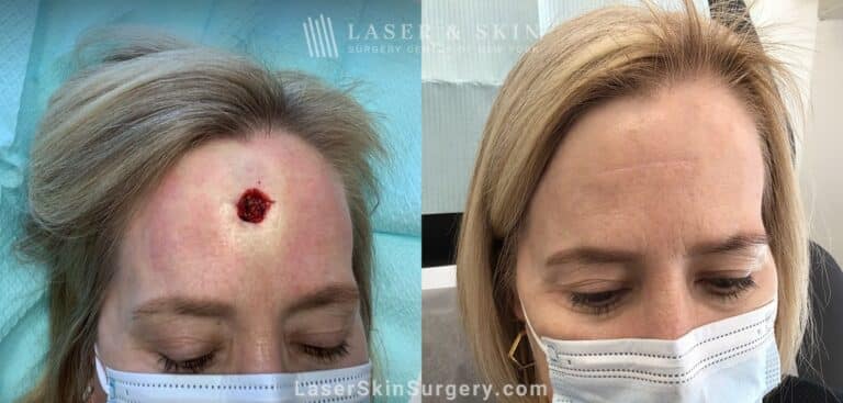 Basal cell carcinoma reconstruction to repair forehead after skin cancer removal